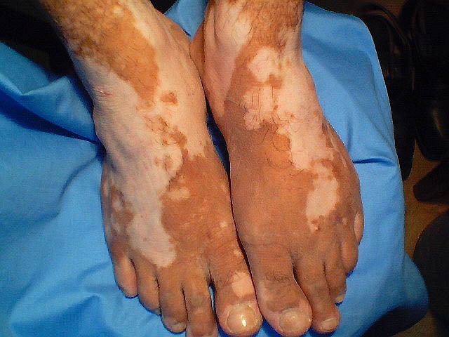 vitiligo on ankles