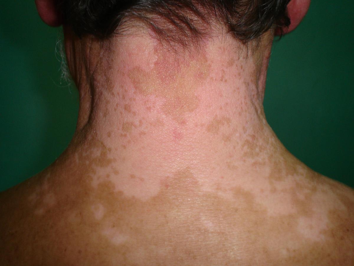 Vitiligo on neck