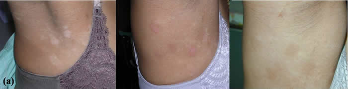 Excimer laser used for vitiligo treatment at armpit
