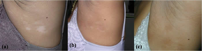 Excimer laser used for vitiligo treatment at armpit