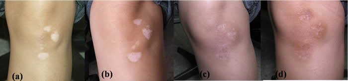Excimer laser used for vitiligo treatment of knee area