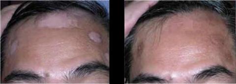 uvb laser treatment vitiligo