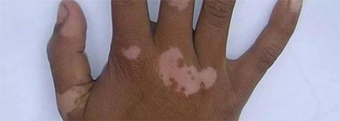 What is vitiligo ?